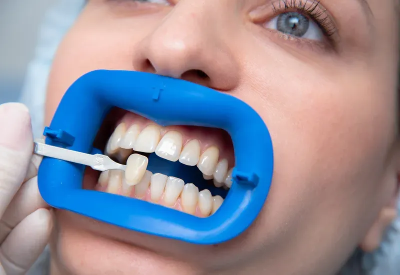 Dental Crowns and Caps: What’s the Difference and Which Do You Need?