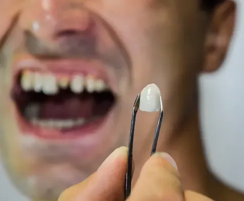 Dental Crowns and Caps: What’s the Difference and Which Do You Need?