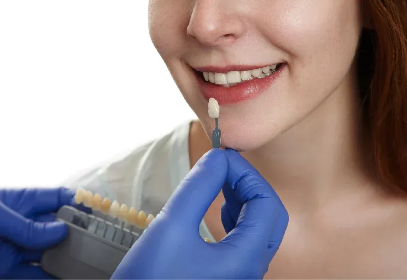 Dental Veneer and Their Role in Smile Enhancement
