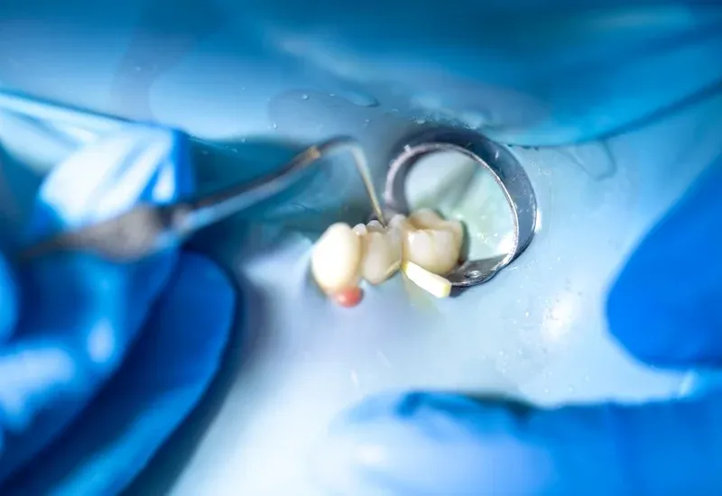 How Long Do Composite Fillings Last