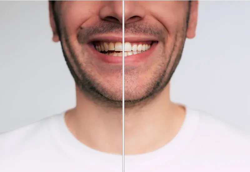 Teeth Whitening & Other Options for Brighter Smiles