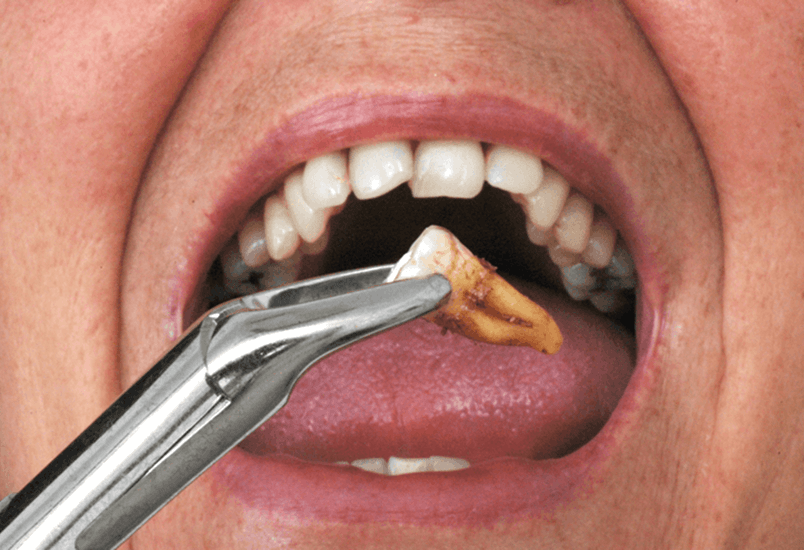 Happy patient pointing to smile